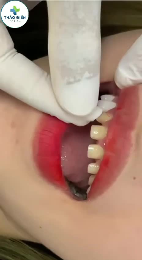 MẶT DÁN SỨ VENEER - GIẢI PHÁP BỌC RĂNG SỨ THỜI THƯỢNG VÀ CAO CẤP
