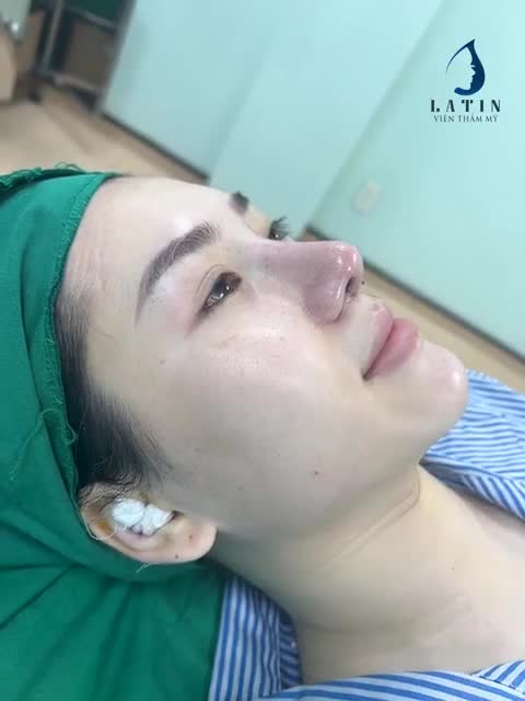 Mũi cấu trúc sửa lại
