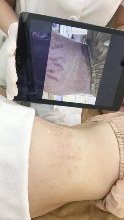 Xóa rạn da nhanh chóng, an toàn, không xâm lấn với công nghệ Vinno Effect tại VTM Xuân Hương.