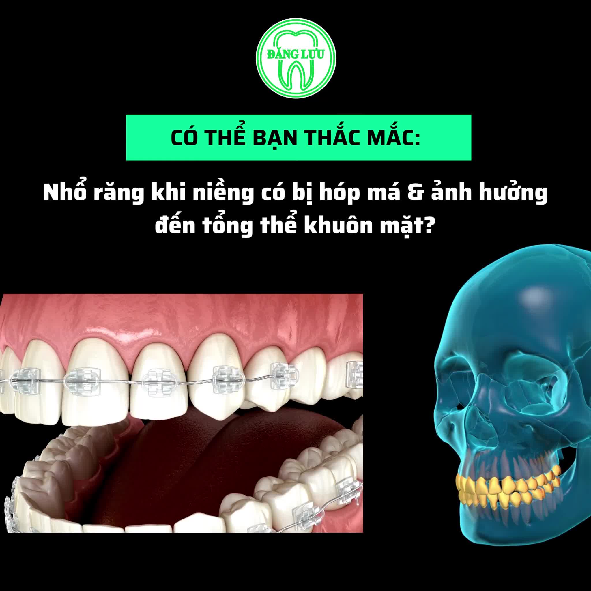 Nhổ răng khi niềng có bị hóp má & ảnh hưởng đến tổng thể khuôn mặt?