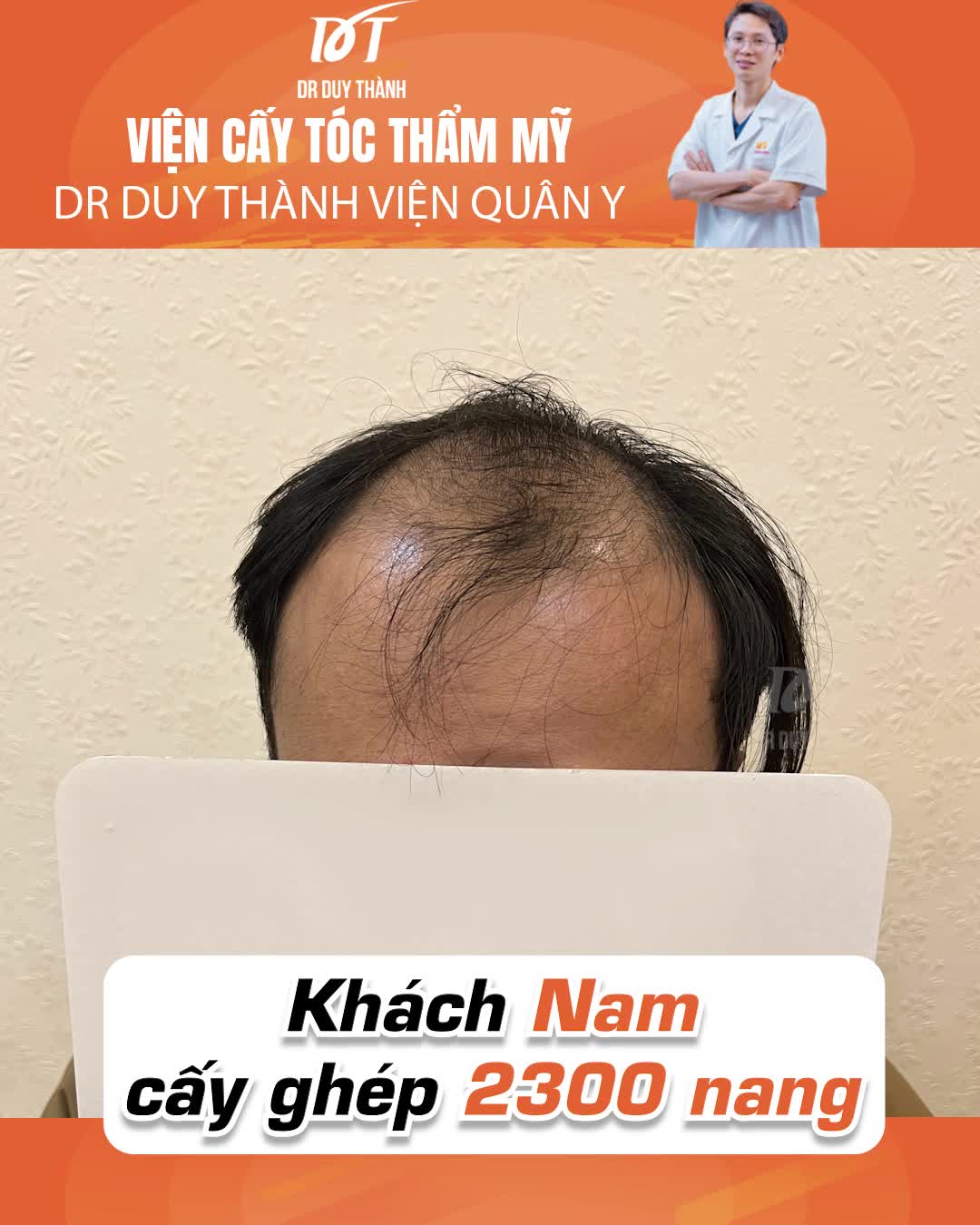 Kết quả sau 10 ngày cấy tóc tự thân