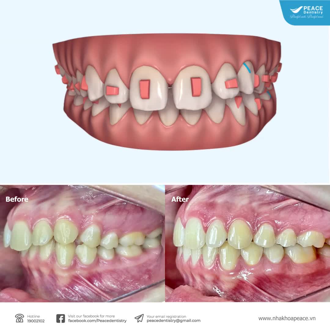NIỀNG RĂNG HÔ HIỆU QUẢ VỚI KHAY NIỀNG TRONG SUỐT INVISALIGN