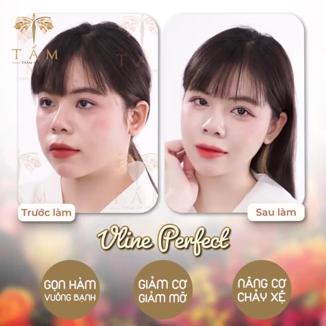 MẶT LỆCH, CƠ CO CỨNG, GÓC HÀM VUÔNG TO, NHIỀU MỠ