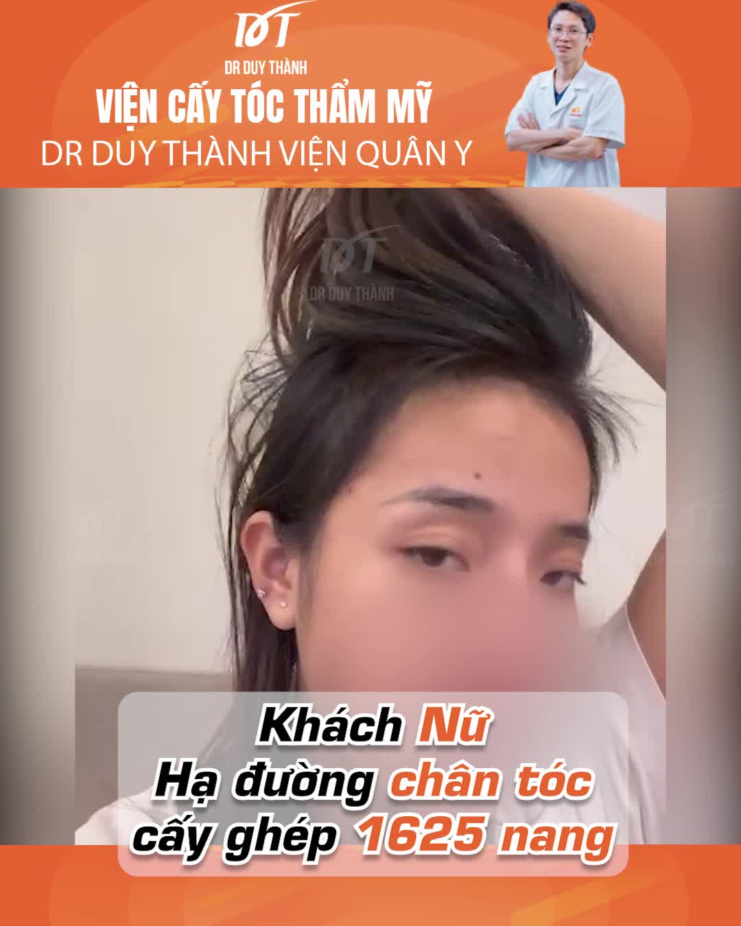 Cấy tóc tự thân nữ - giải cứu trán dô