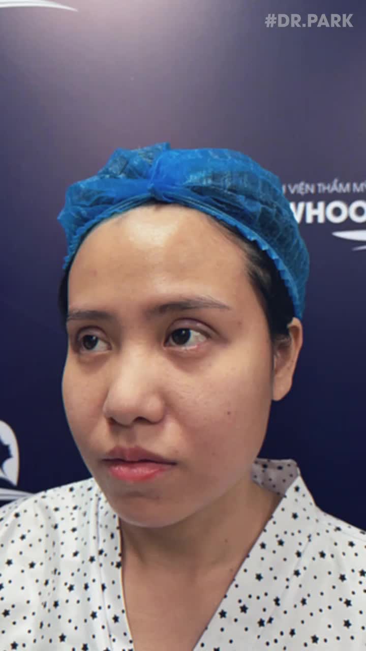 VÌ SAO NGÀY NAY NGƯỜI NGƯỜI NHÀ NHÀ CHỌN NÂNG MŨI CẤU TRÚC?