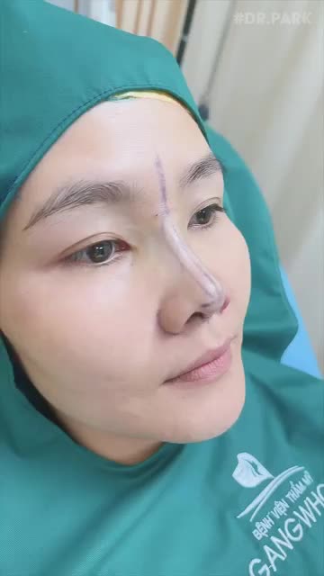 NÂNG MŨI CẤU TRÚC THAY ĐỔI NHỮNG DÁNG MŨI NÀO
