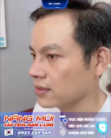 CÔNG NGHỆ NÂNG MŨI PHÙ HỢP CHO NAM GIỚI