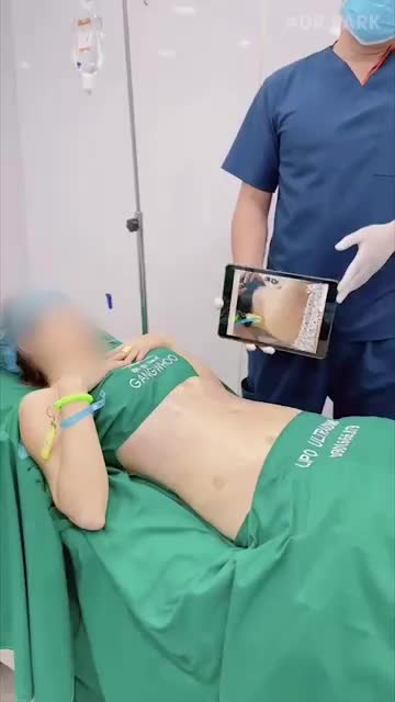 CÓ NÊN ĐI HÚT MỠ KHÔNG?
