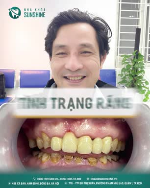 TUỔI TRUNG NIÊN BỌC RĂNG SỨ ĐƯỢC KHÔNG?