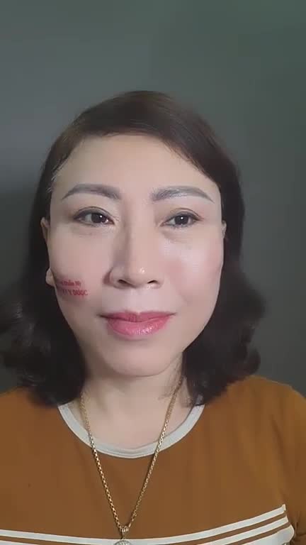 Kết quả Căng da mặt sau 45 ngày do chính tay bác sĩ Kỳ thực hiện.