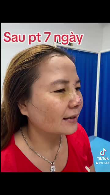 Trên cành gió thổi đong đưa Nếu chưa nâng mũi thì qua Thảo Điền!