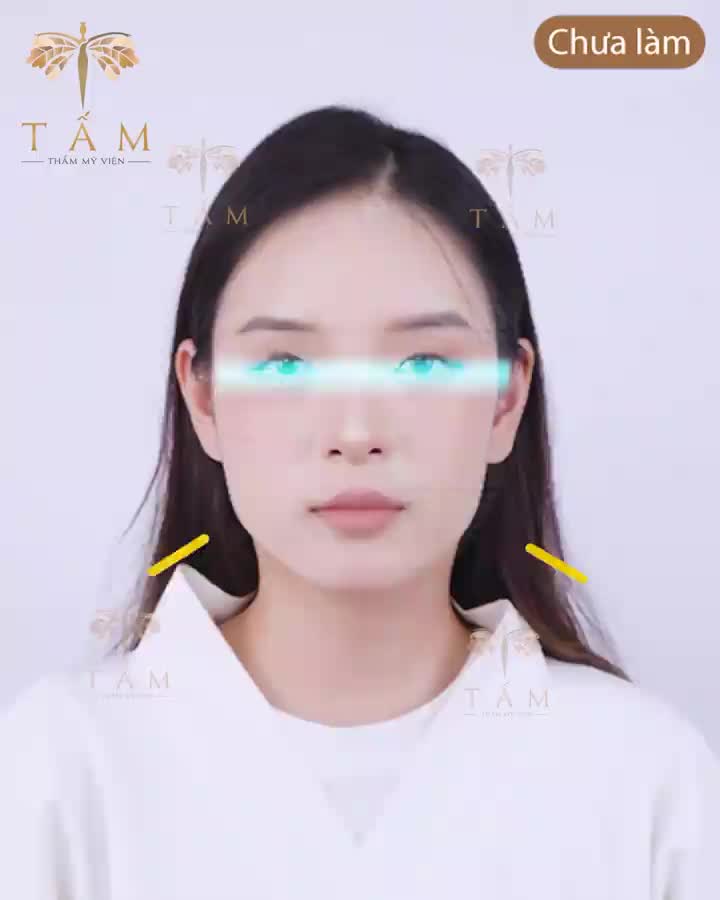 Tạm biệt mặt vuông, khuôn hàm to bạnh khiến gương mặt bạn bị thô kệch, thiếu sự duyên dáng