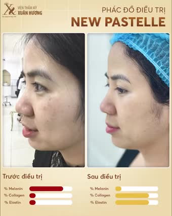 NÁM là thủ phạm từ một cô gái xinh đẹp, tràn đầy sức sống bỗng trở nên:  Một phụ nữ xấu xí, già nua khiến họ thấy tự ti. Da thâm sạm, kém hấp dẫn