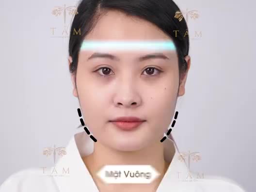 VLINE PERFECT THON GỌN HÀM - BÍ KÍP TẠO NÊN GƯƠNG MẶT HOÀN MỸ