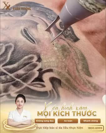 MỤC SỞ THỊ QUÁ TRÌNH XÓA XĂM TẠI VTM XUÂN HƯƠNG