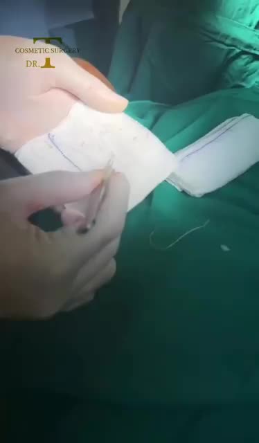 Ca phẫu thuật tháo mũi chỉ bên trong mũi ra sau 1 năm và đặt lại sóng mũi bằng phương pháp nâng mũi CLNT ghép sụn tai.