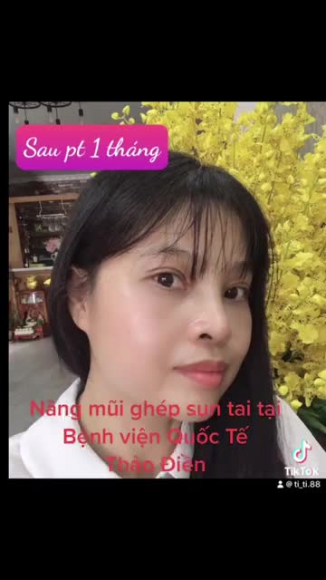 1 Chiếc mũi cao tây nhẹ nhàng tự nhiên sau 3 tháng tuổi tại Bệnh viện Quốc Tế Thảo Điền