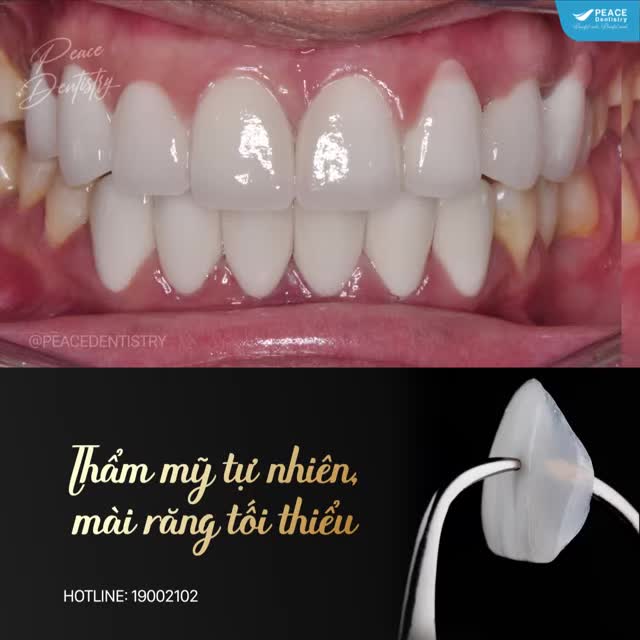 MẶT DÁN SỨ VENEER TẠI PEACE DENTISTRY CÓ GÌ KHÁC BIỆT?