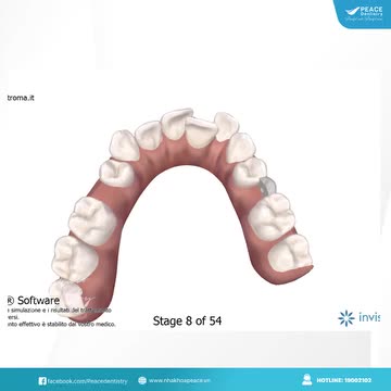CLINCHECK trong chỉnh nha invisalign