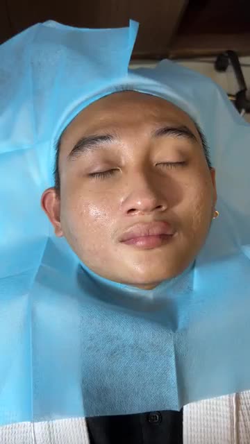 Hành trình TRỊ MỤN TRỨNG CÁ kết hợp ĐIỀU TRỊ SẸO RỖ cho nam sinh tự tin tỏa sáng