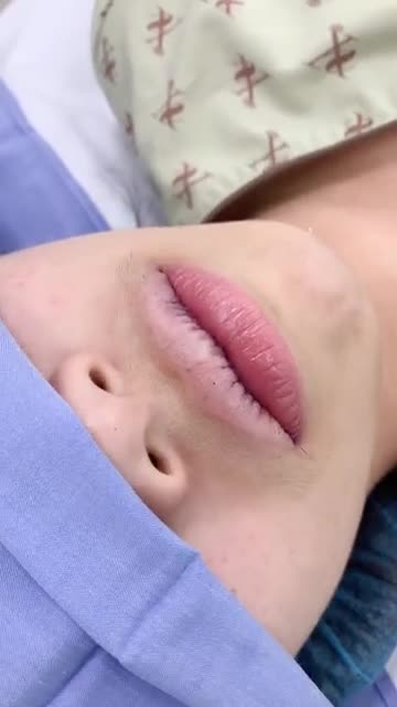 Ca thu gọn môi sau 30 phút