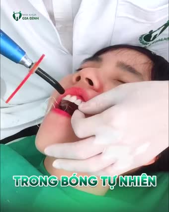 DÁN SỨ VENEER: THAY ĐỔI NỤ CƯỜI - TƯƠNG LAI TƯƠI SÁNG
