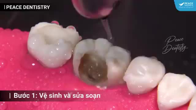 TRÁM RĂNG SÂU, GÃY, MẺ, THƯA