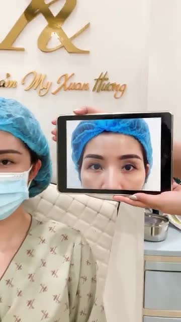 Thái dương hóp lõm, biện pháp nào là hiệu quả nhất