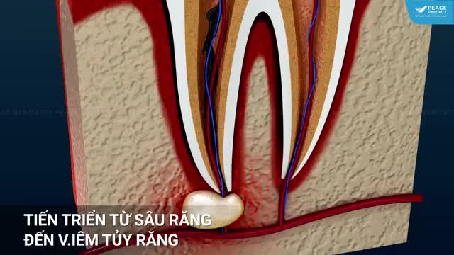 HƯ TỦY, VỠ DẦN RĂNG VÀ MẤT RĂNG SỚM - 3 HỆ QUẢ THƯỜNG GẶP DO SÂU RĂNG