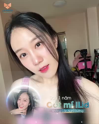 FEEDBACK XỊN SAU 1 NĂM CẮT MÍ TẠI LA RATIO