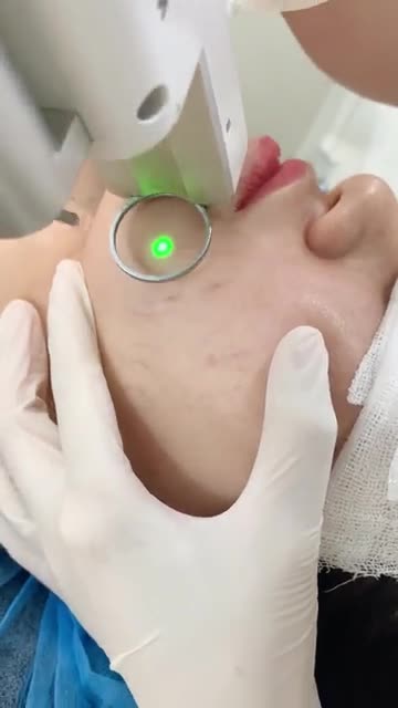 Makeup cũng không che nổi mao mạch trên mặt, chị khách hàng tìm đến Xuân Hương nhờ giúp đỡ