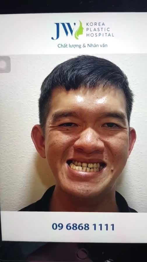 MÊ MẨN với KẾT QUẢ PHẪU THUẬT HÀM MÓM + NIỀNG RĂNG đẹp chuẩn HOTBOY của anh chàng MẶT LỆCH Trước đây, tình trạng của anh bị hàm móm, lệch và răng lộn xộn rất nhiều khiến anh luôn cảm thấy tự ti và mặc cảm.