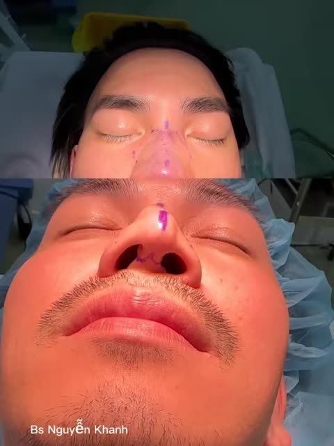 Chiếc mũi uốn lượn, lộ chóp, trụ mũi nghiêng và điều quan trọng hơn là chưa xử lý được xương bè 2 bên sóng của bạn khách.