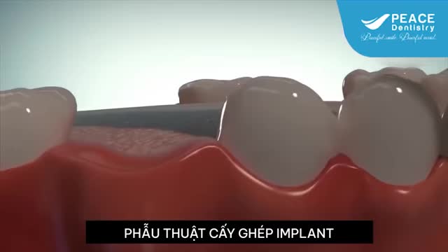 PEACE DENTISTRY - TRUNG TÂM CẤY GHÉP IMPLANT NHA KHOA HÀNG ĐẦU TP.HCM