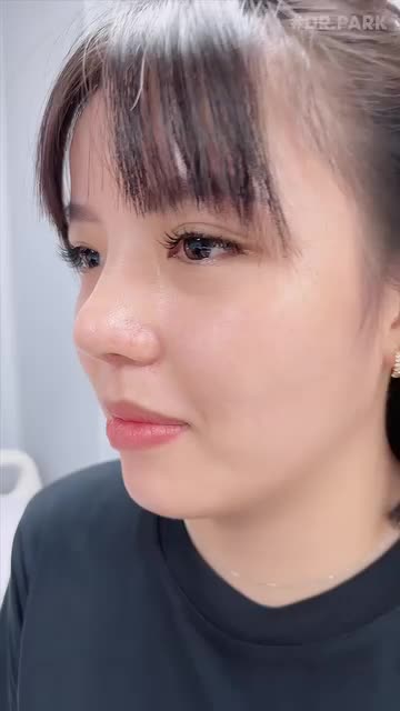 THỜI GIAN SƯNG BẦM CỦA KHÁCH HÀNG SAU NÂNG MŨI LÀ BAO LÂU?