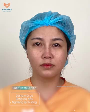 SỬA MŨI LỆCH HỎNG - TẠO HÌNH DÁNG MŨI CAO THON
