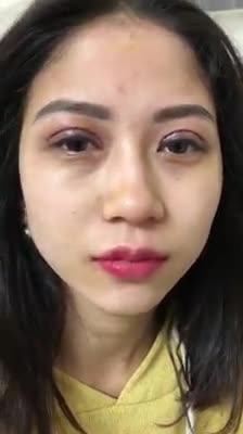 Hình ảnh ngay sau khi cắt mí