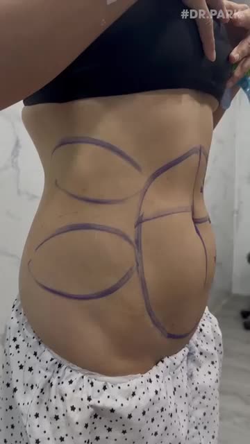 MỠ BỤNG: VÌ SAO NÊN GIẢM CÀNG SỚM CÀNG TỐT?