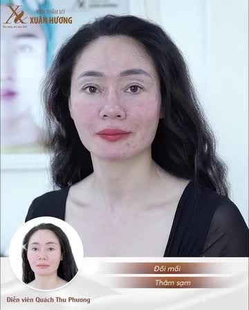 BÁO ĐỘNG: CÁC TÌNH TRẠNG DA BÁO HIỆU BẠN CẦN THỰC HIỆN TRẺ HÓA DA PRP