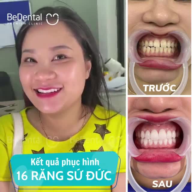 Hết răng hô thưa, ố vàng - Phục hình 16 răng sứ Đức