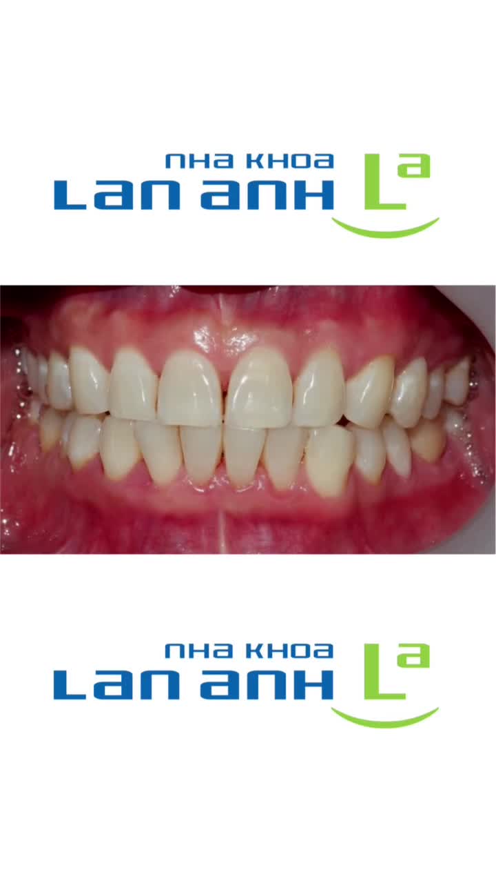 Khám phá đặc điểm độc đáo của Công Nghệ Tẩy Trắng Răng Zoom Whitening