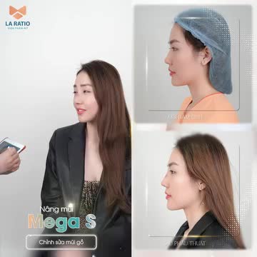 NÂNG MŨI CẤU TRÚC MEGA S - CHỈNH SỬA MŨI GỒ HIỆU QUẢ