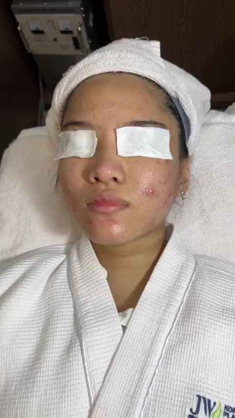 GIẬT MÌNH hiệu quả ĐIỀU TRỊ SẸO ngoạn mục cho nữ sinh GEN Z