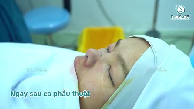 Combo Mũi Sụn Sườn + Xử Lý Da Thừa Mí Phải Cho Cô Bạn Ở Mỹ