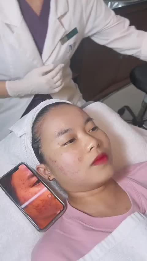 MỤN VIÊM TOÀN MẶT do điều trị không đúng cách Nữ Khách Hàng 9X tìm JW giải cứu và KẾT QUẢ BẤT NGỜ