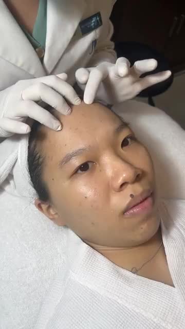 COI LÀ GHIỀN: Bác sĩ JW laser ĐIỀU TRỊ MỤN tận gốc cho nữ sinh GEN Z