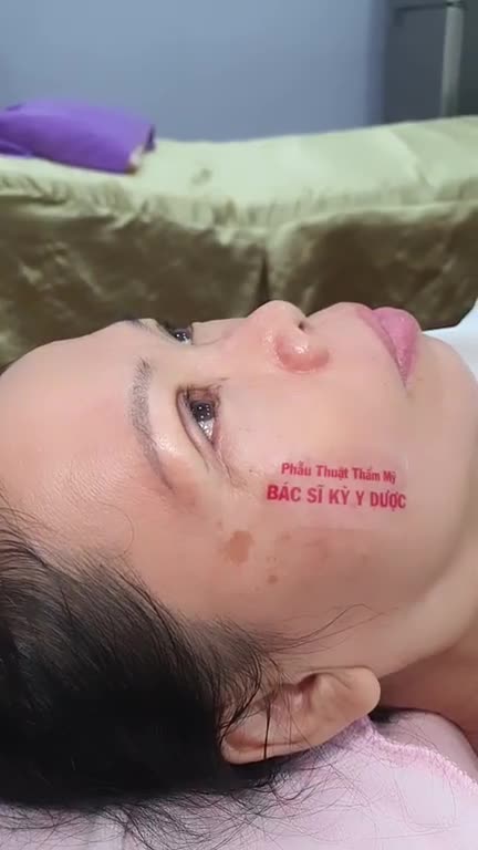 Chỉ sau 10 ngày cắt mí trên PLASMA: