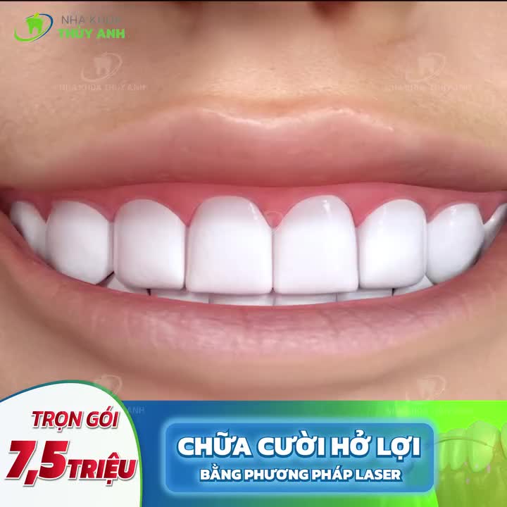 CHỮA CƯỜI HỞ LỢI - ĐẸP NGAY ĐÓN TẾT
