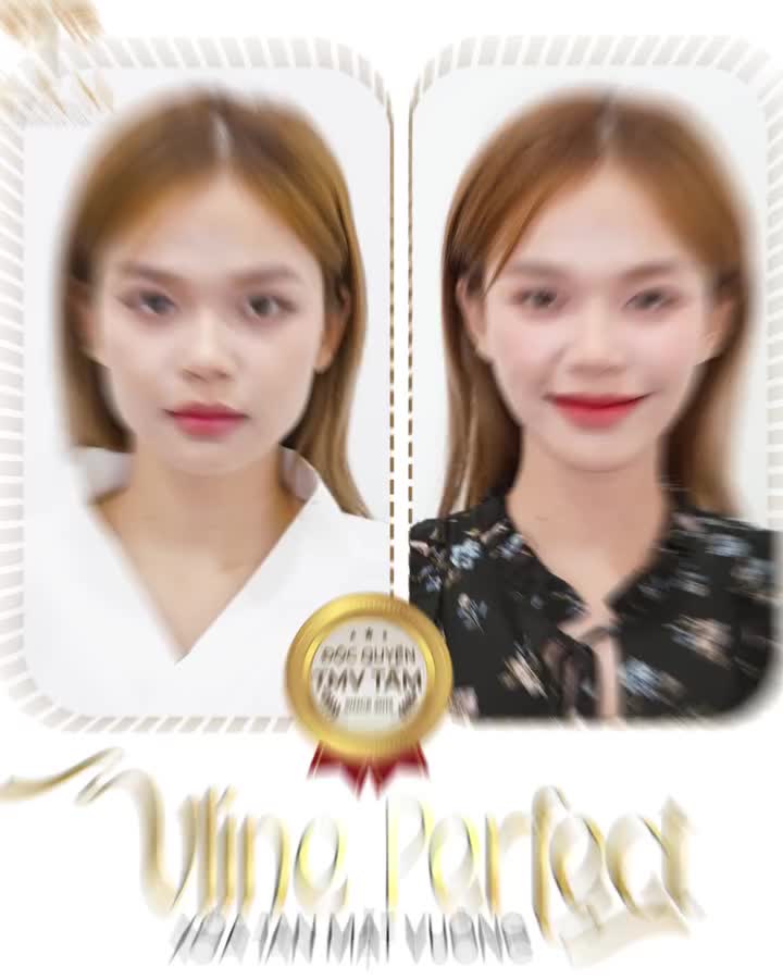 THON GỌN HÀM VLINE PERFECT -  BIẾN KHUYẾT ĐIỂM THÀNH TÂM ĐIỂM