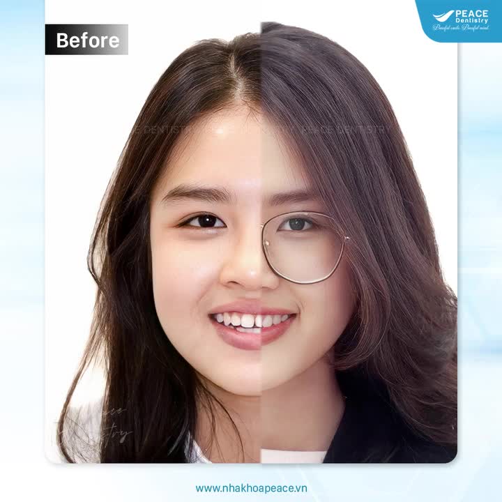 Sau niềng răng, kết quả nhận được sẽ là gì?